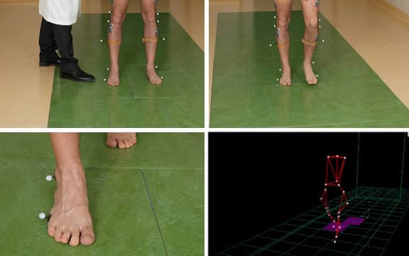 gait-analysis